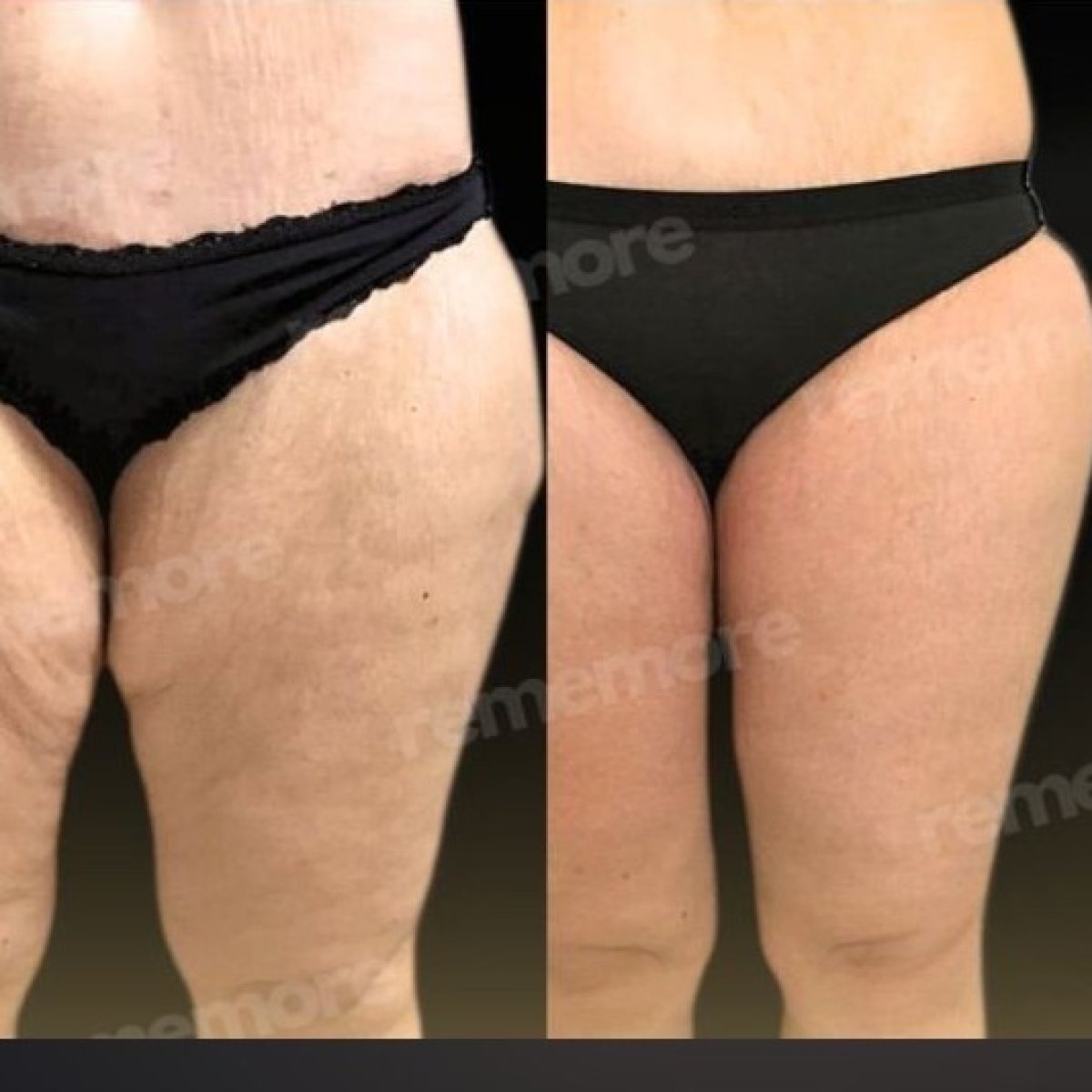 Before and after liposuction results at Memorial Şişli Hospital, thigh contour improvement