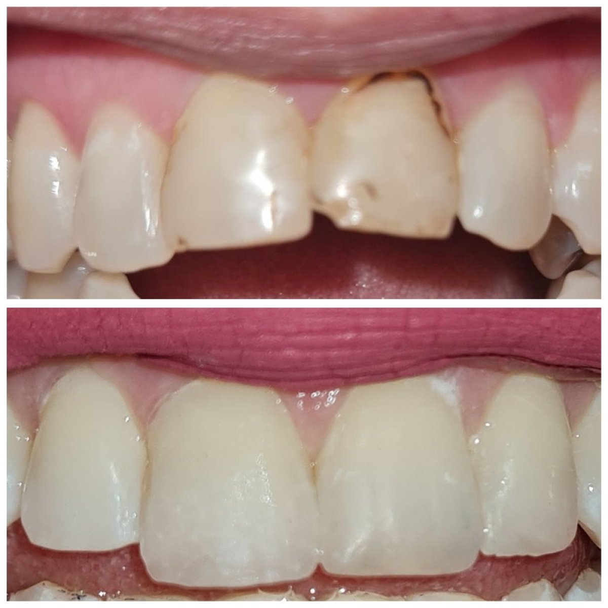 نتائج قبل وبعد ترميم الأسنان الأمامية بتقنية البوندينغ في SoftDentalCare Clinic