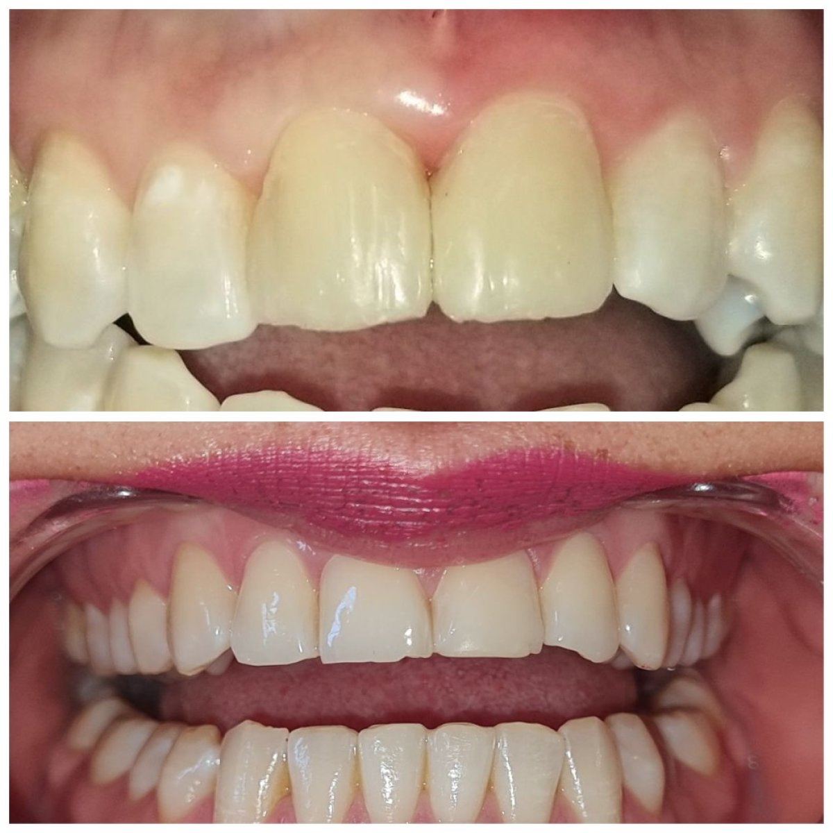 Before and after dental bonding results at SoftDentalCare Clinic – improved tooth color and shape