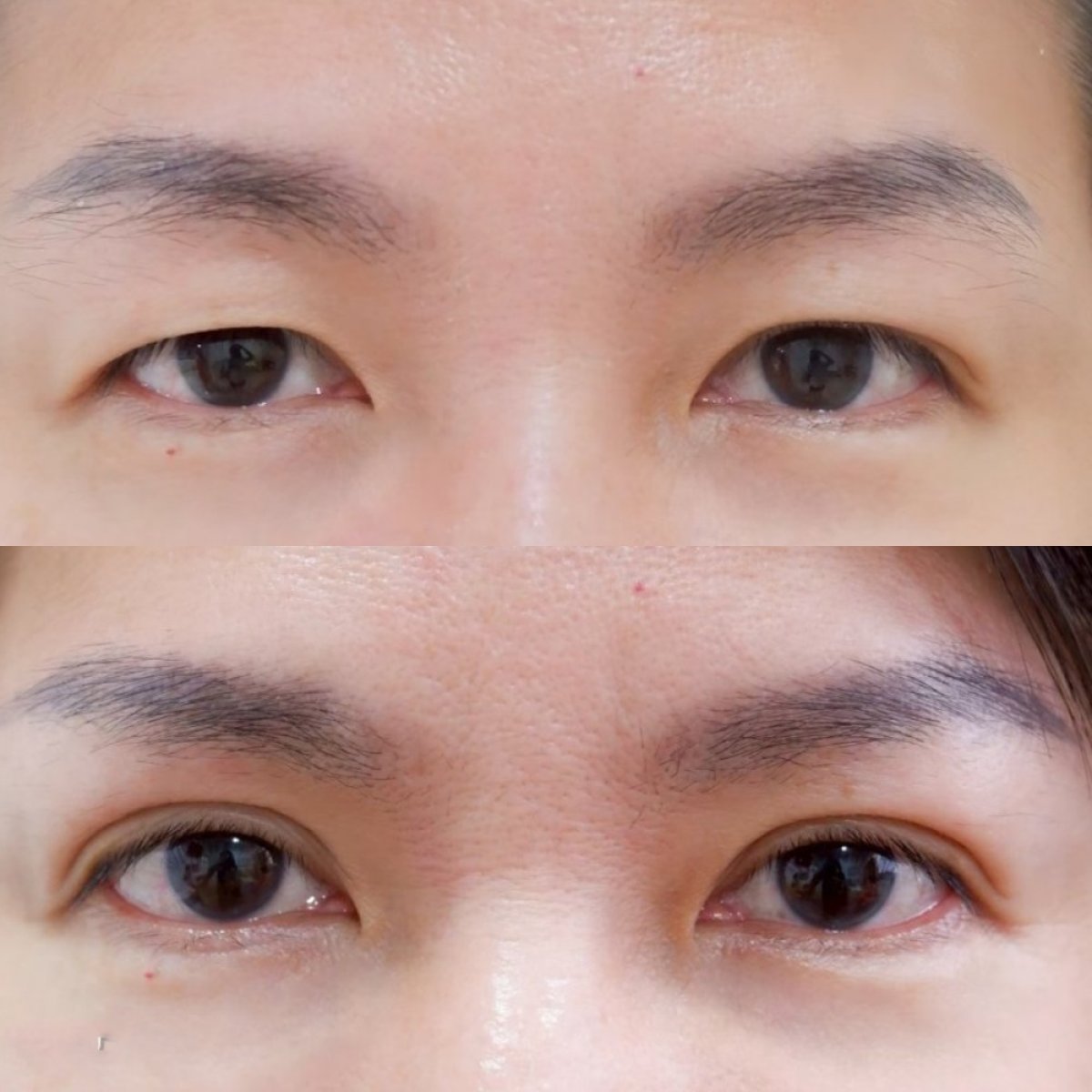 Resultados de blefaroplastia antes y después en Somchai Clinic, corrección de párpados