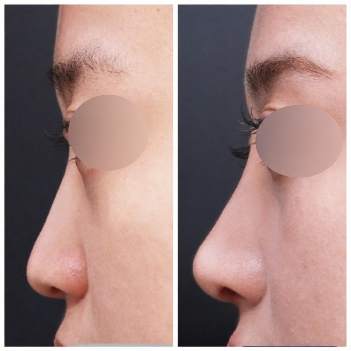 Before and after rhinoplasty results at VG Plastic Surgery, improved nose profile and contour
