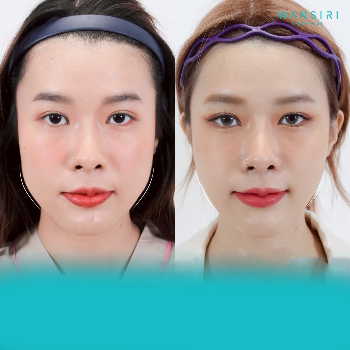 Resultados antes y después de remodelación de mandíbula en Wansiri Hospital, mejora facial