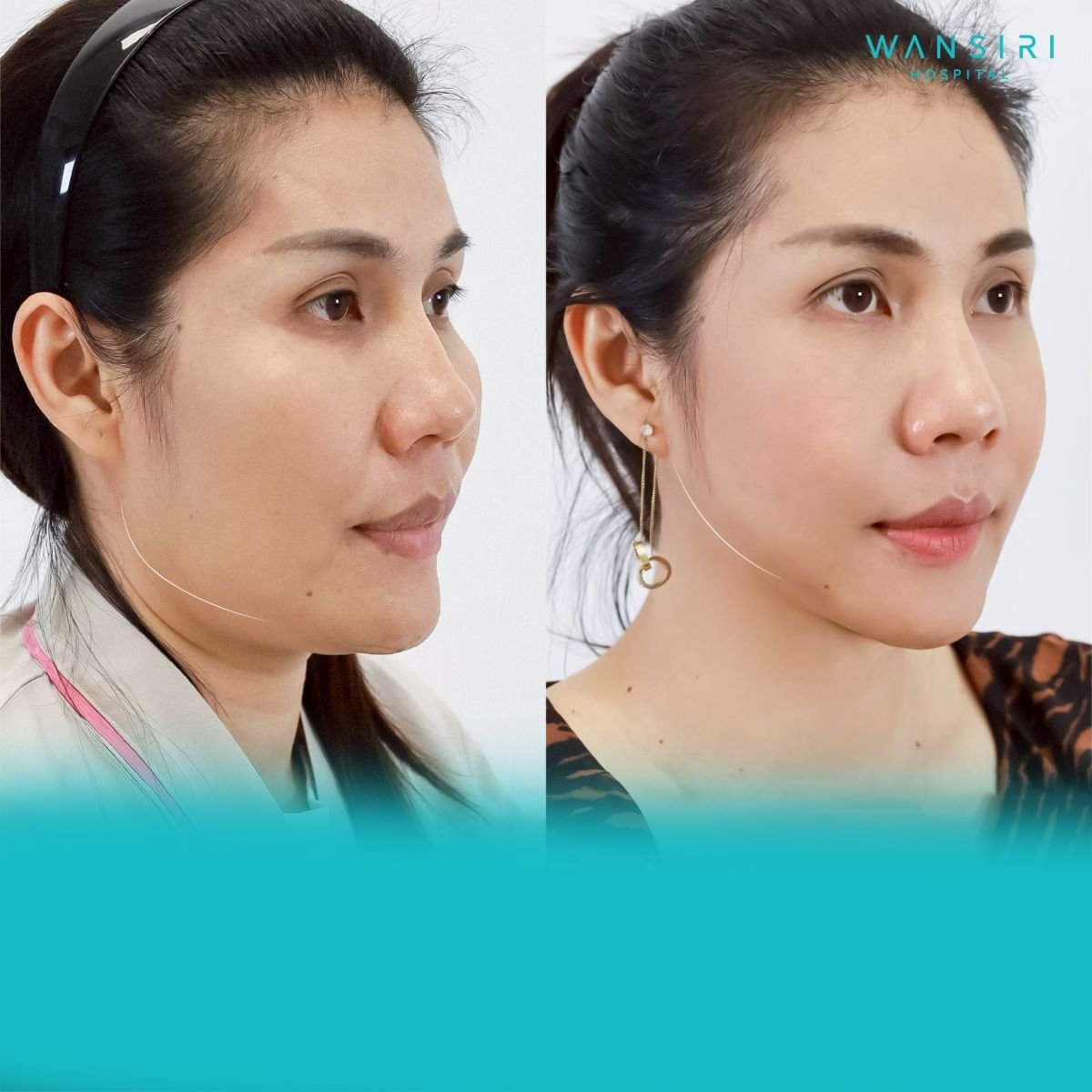 Resultados antes y después de modelado de mandíbula en Wansiri Hospital, contorno facial mejorado
