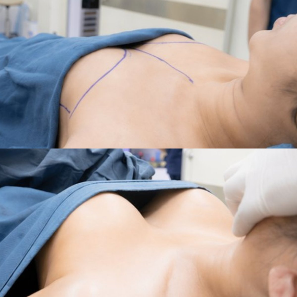 نتائج قبل وبعد تكبير الثدي في عيادة Cosmacare، تحسين شكل الثدي