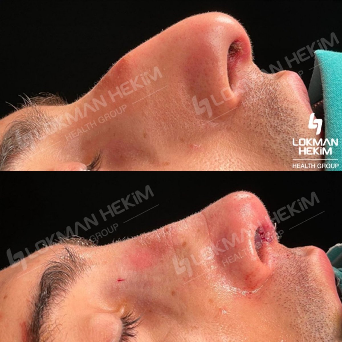 Resultados de rinoplastia antes y después en Lokman Hekim Istanbul Hospital, remodelación nasal