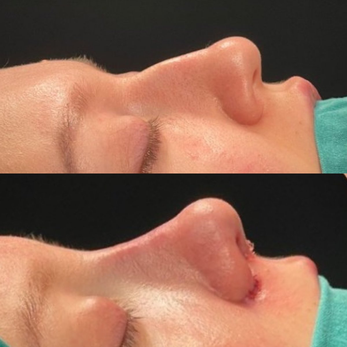 نتائج عملية تجميل الأنف قبل وبعد في مستشفى لوكمان حكيم إسطنبول، إعادة تشكيل الأنف