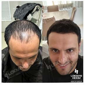 Premium Hair transplant (2000-4500 Grafts) All Included - photo 5