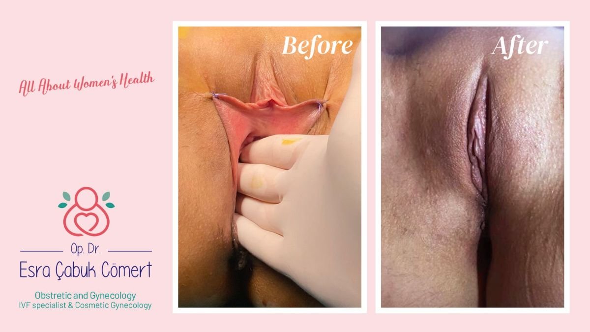 نتائج قبل وبعد عملية تجميل الشفرين في عيادة د. إسراء جابوك جومرت، مظهر محسن