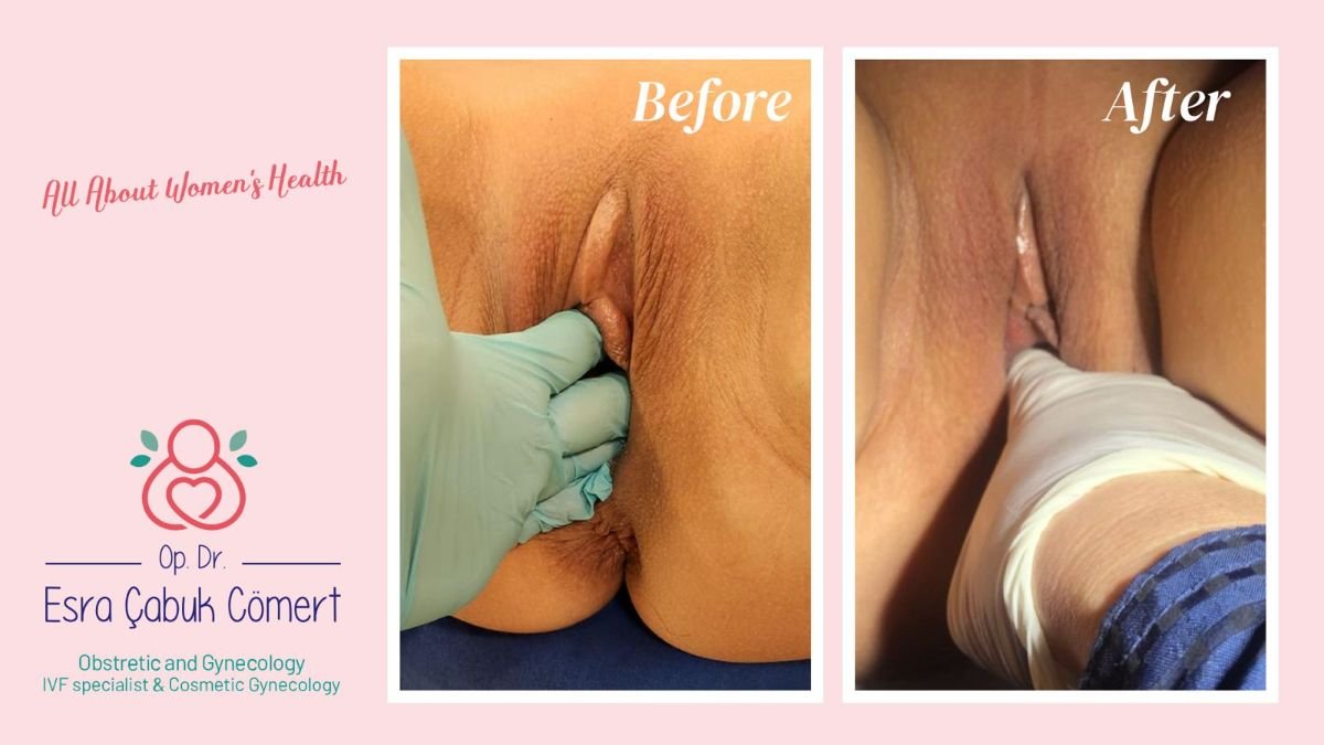 نتائج عملية تجميل الشفرين قبل وبعد في عيادة د. إسراء تشابوك جومرت، تحسين المظهر