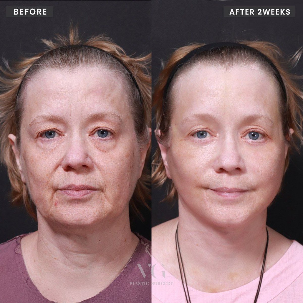 До и после липофилинга лица в VG Plastic Surgery, видимый омолаживающий результат