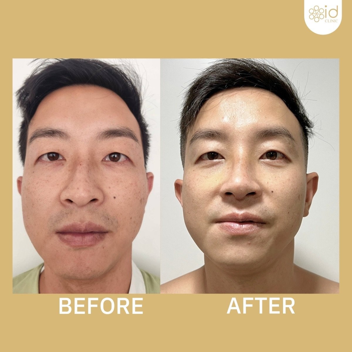 Before and after rhinoplasty results at ID Clinic Bangkok, improved nose shape and symmetry