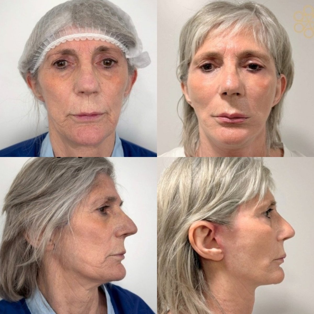 Deep Plane Facelift before and after results at ID Clinic Bangkok, visible facial rejuvenation