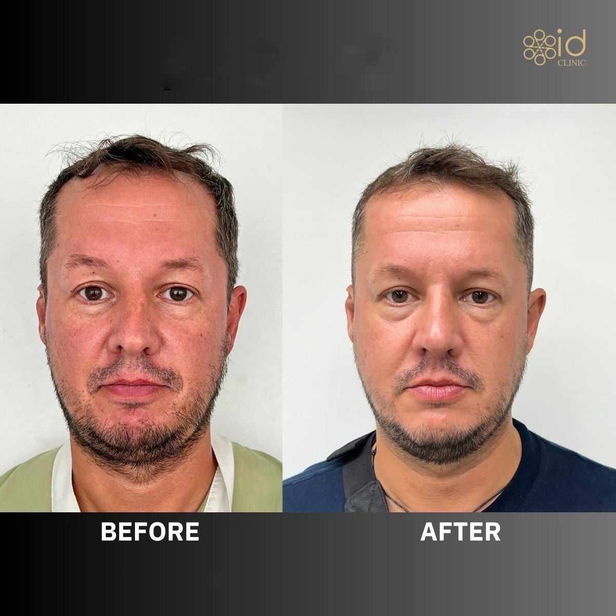 Before and after rhinoplasty results at ID Clinic Bangkok, improved nose shape and symmetry