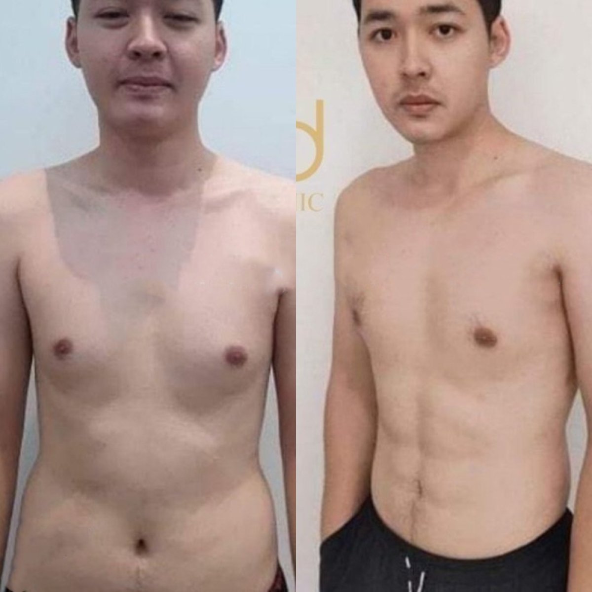 Before and after love handles liposuction results at ID Clinic Bangkok, improved waist contour