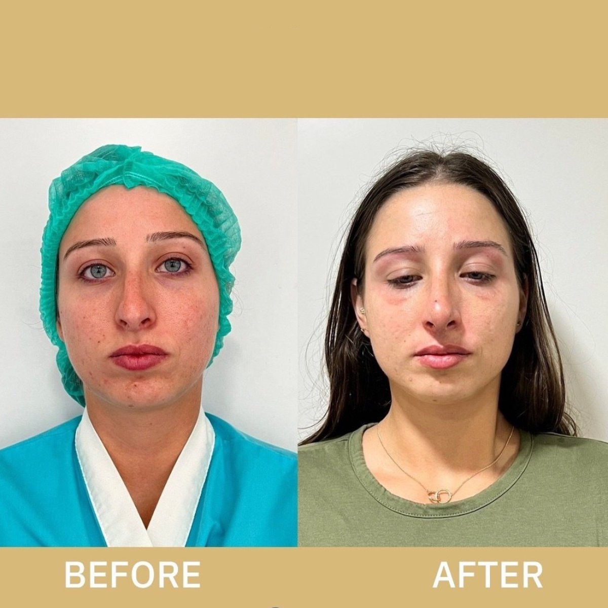 Before and after ultrasonic rhinoplasty result at ID Clinic Bangkok, nose reshaping outcome