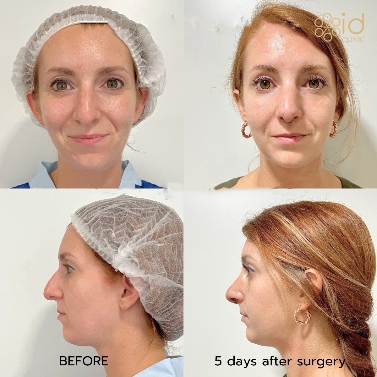 Before and after ultrasonic rhinoplasty results at ID Clinic Bangkok, nose reshaping visible