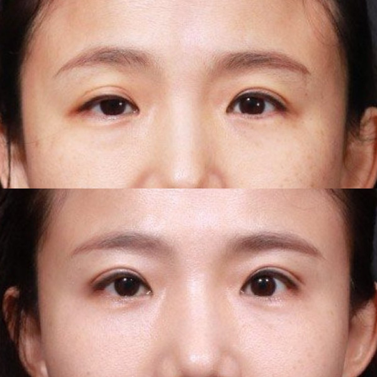 Blepharoplasty before and after results at VG Plastic Surgery – eyelid correction improvement