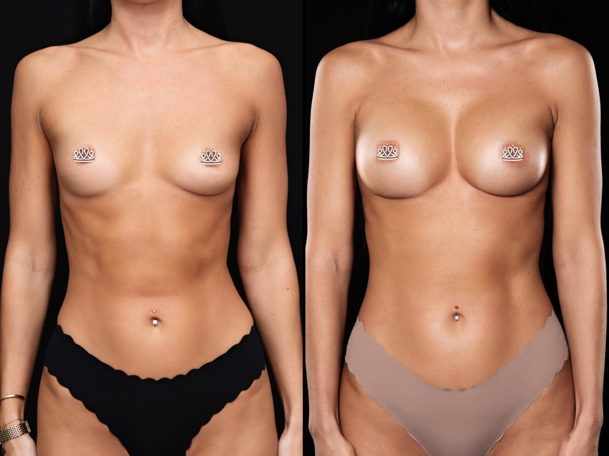 Résultats avant/après augmentation mammaire à la Vidnova Clinic – volume des seins accru