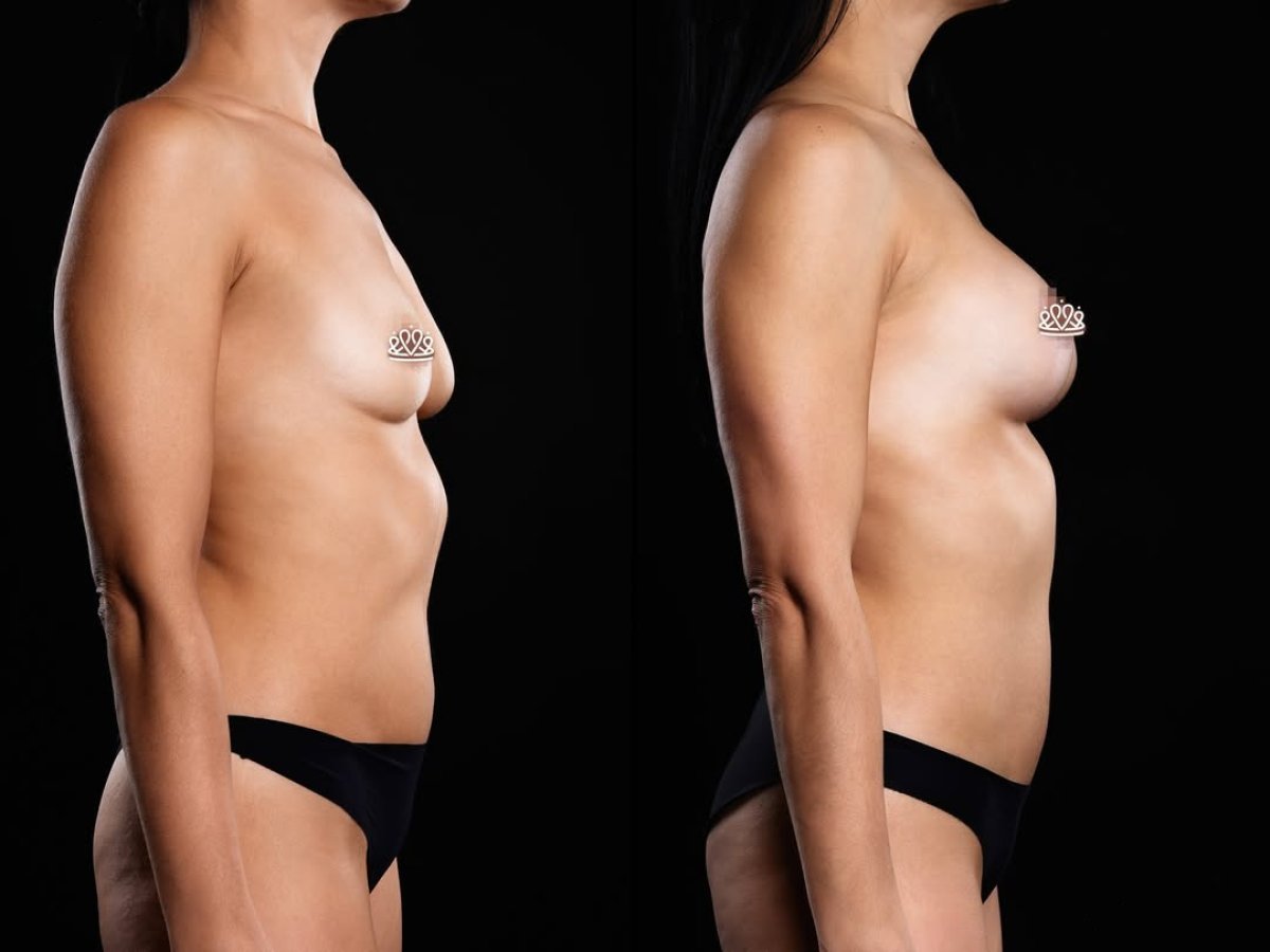 Before and after breast augmentation results at Vidnova Clinic – enhanced breast shape