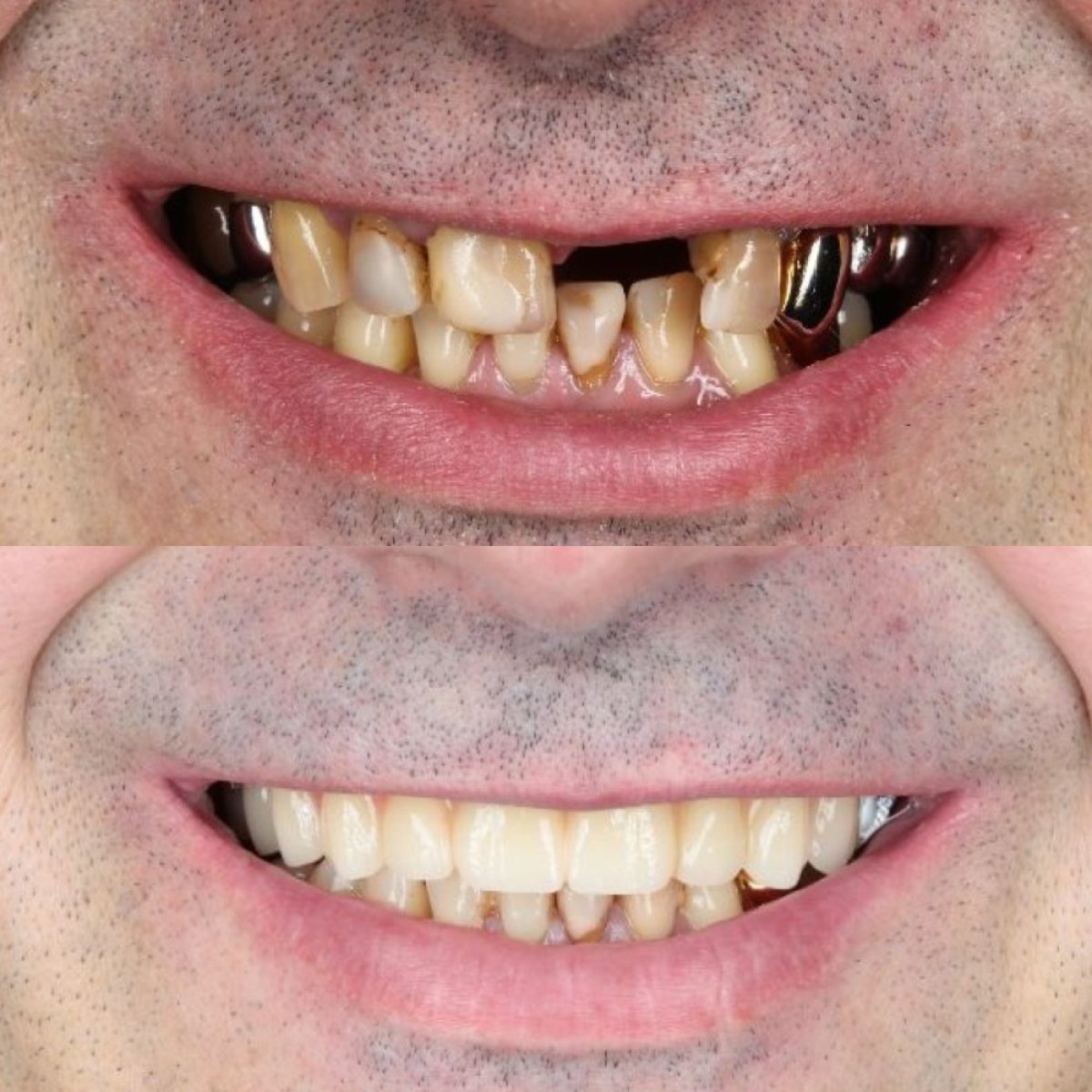 Resultados antes y después de implantes All-on-4 en Dental Clinic Dynasty Stomatology Praga