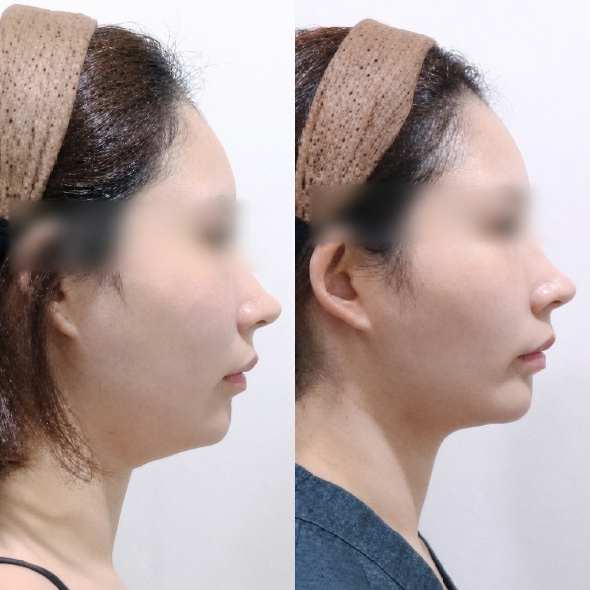 Resultados de Ultherapy antes y después en Lalian Cheongdam Clinic – línea de mandíbula definida