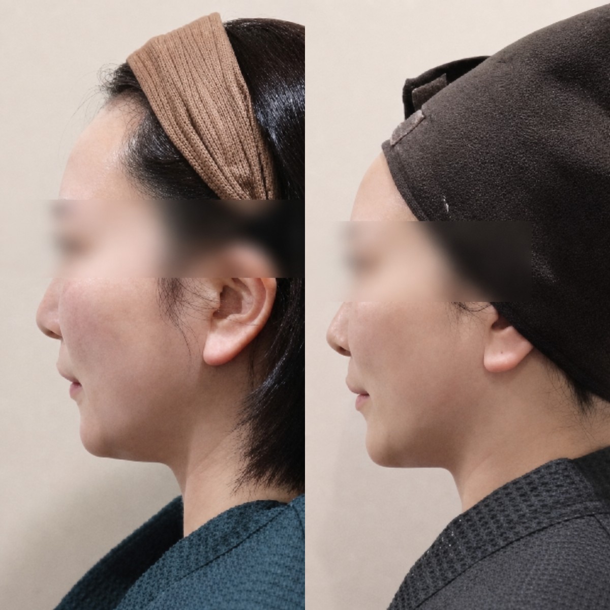 Before and after Thermage results at Lalian Cheongdam Clinic, visible facial contour improvement