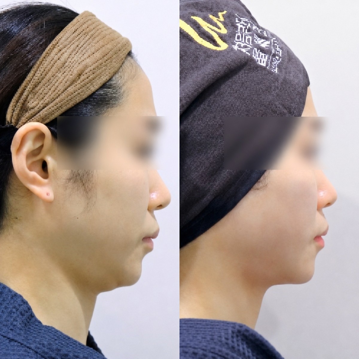 Facelift before and after results at Lalian Cheongdam Clinic, visible jawline improvement