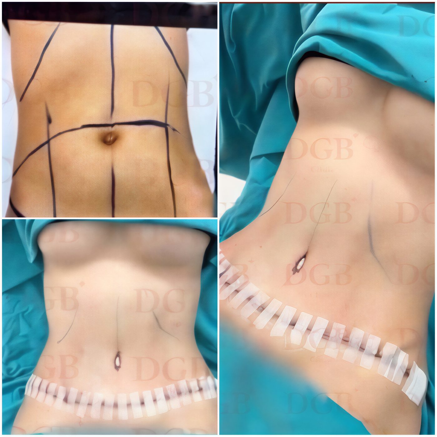 Resultados de abdominoplastia y liposucción antes y después en DGB Clinic, mejor contorno abdominal