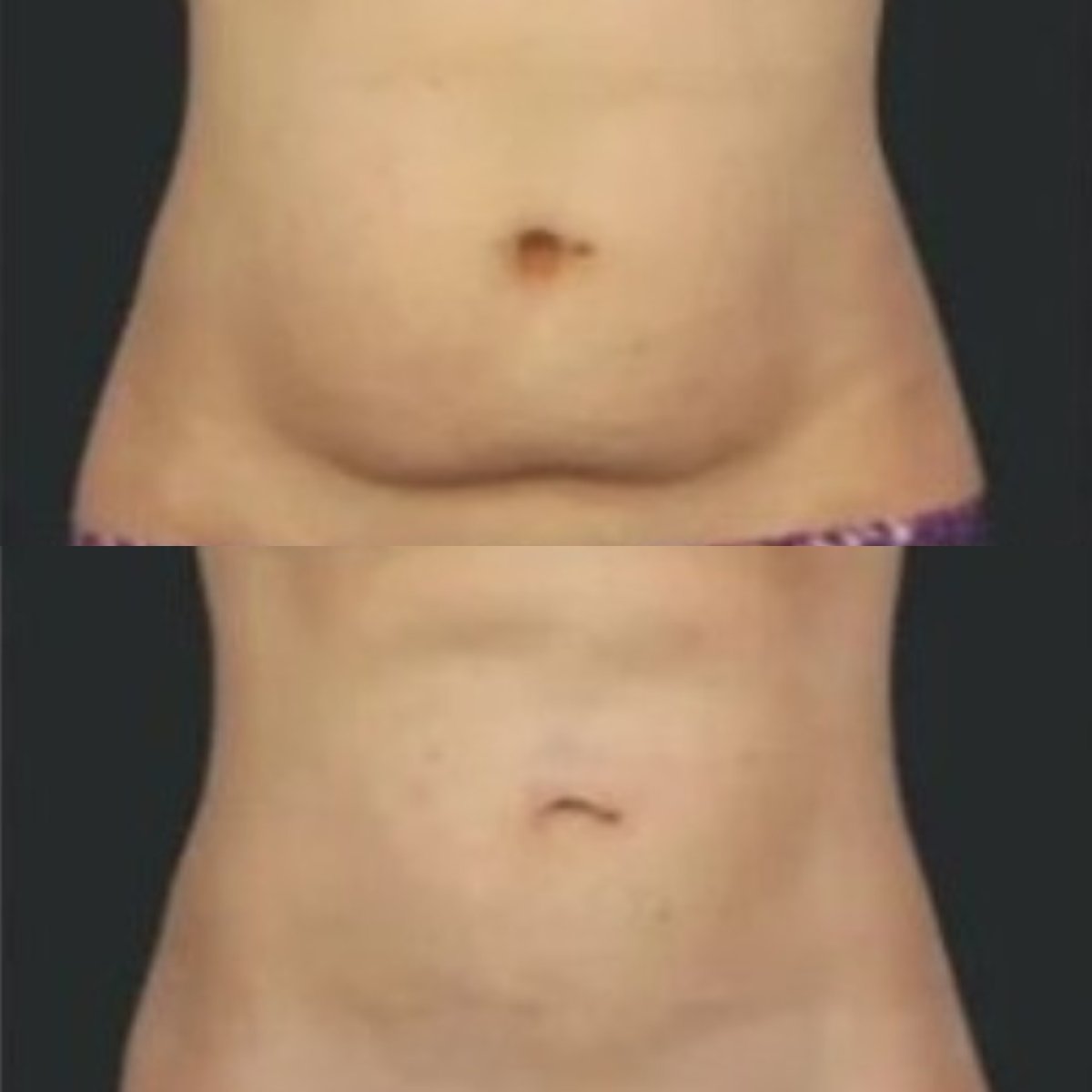 Before and after cryolipolysis results at Alpha Beauty Hannover, visible abdominal fat reduction
