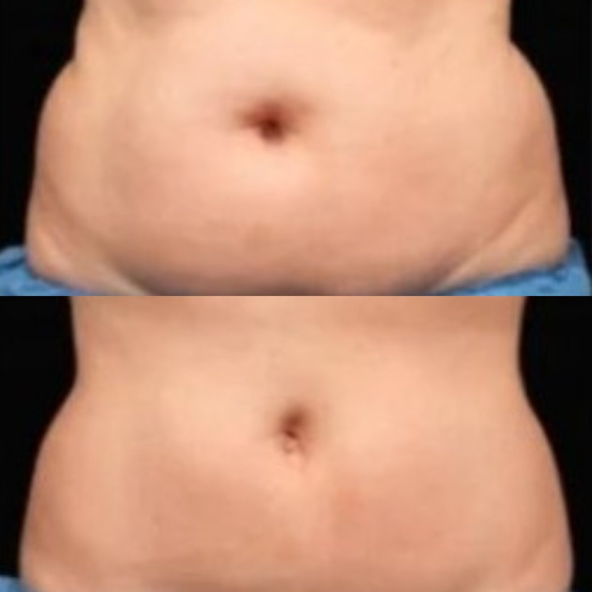 Before and after cryolipolysis (Coolsculpting) results at Alpha Beauty Hannover, abdomen contour