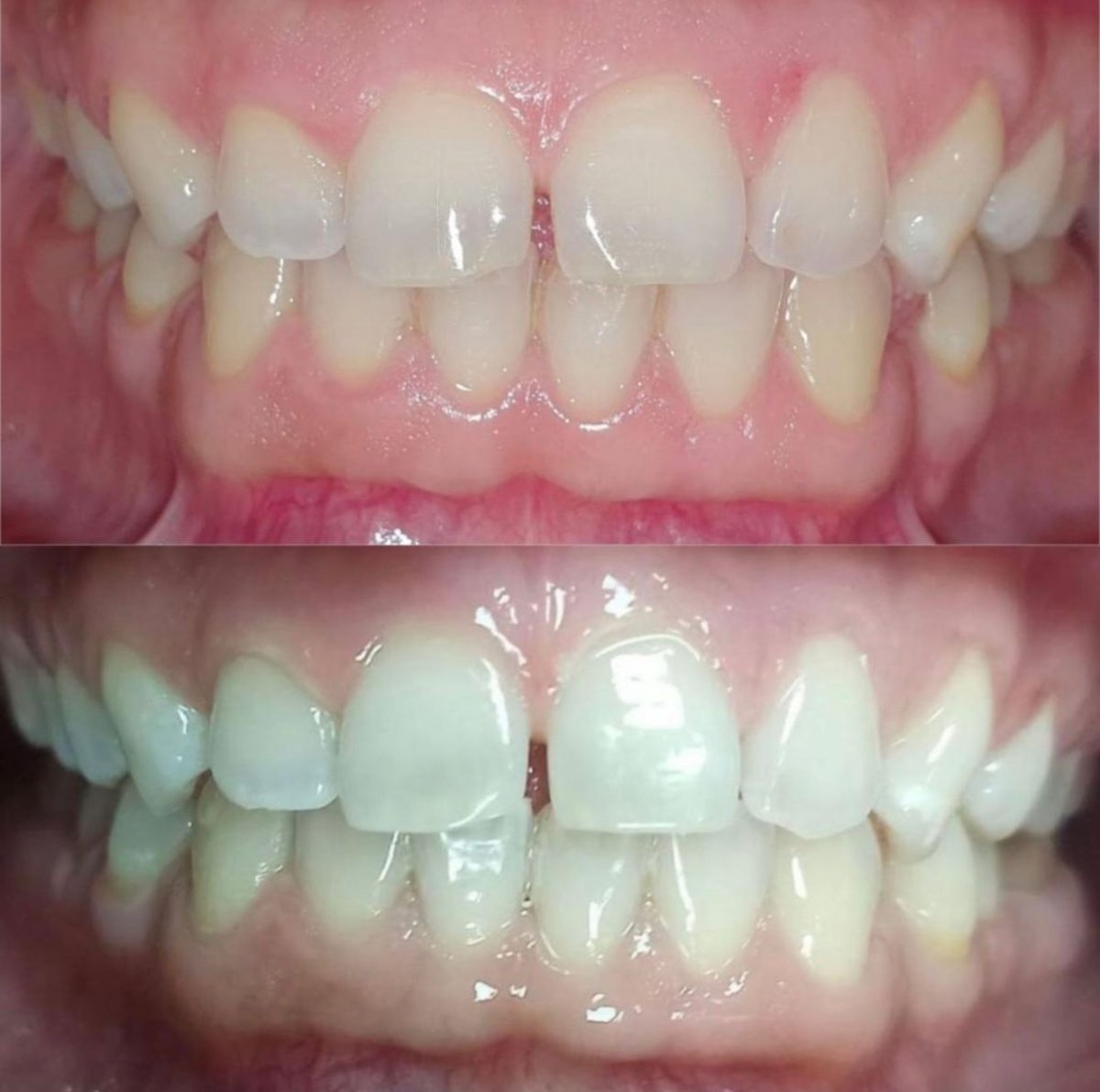نتائج قبل وبعد تبييض الأسنان بالليزر في Grand Dental Hospital & Laboratory