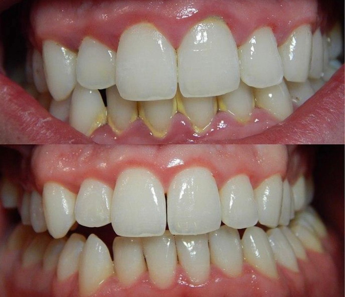 Результаты лазерного отбеливания зубов до и после в Grand Dental Hospital & Laboratory
