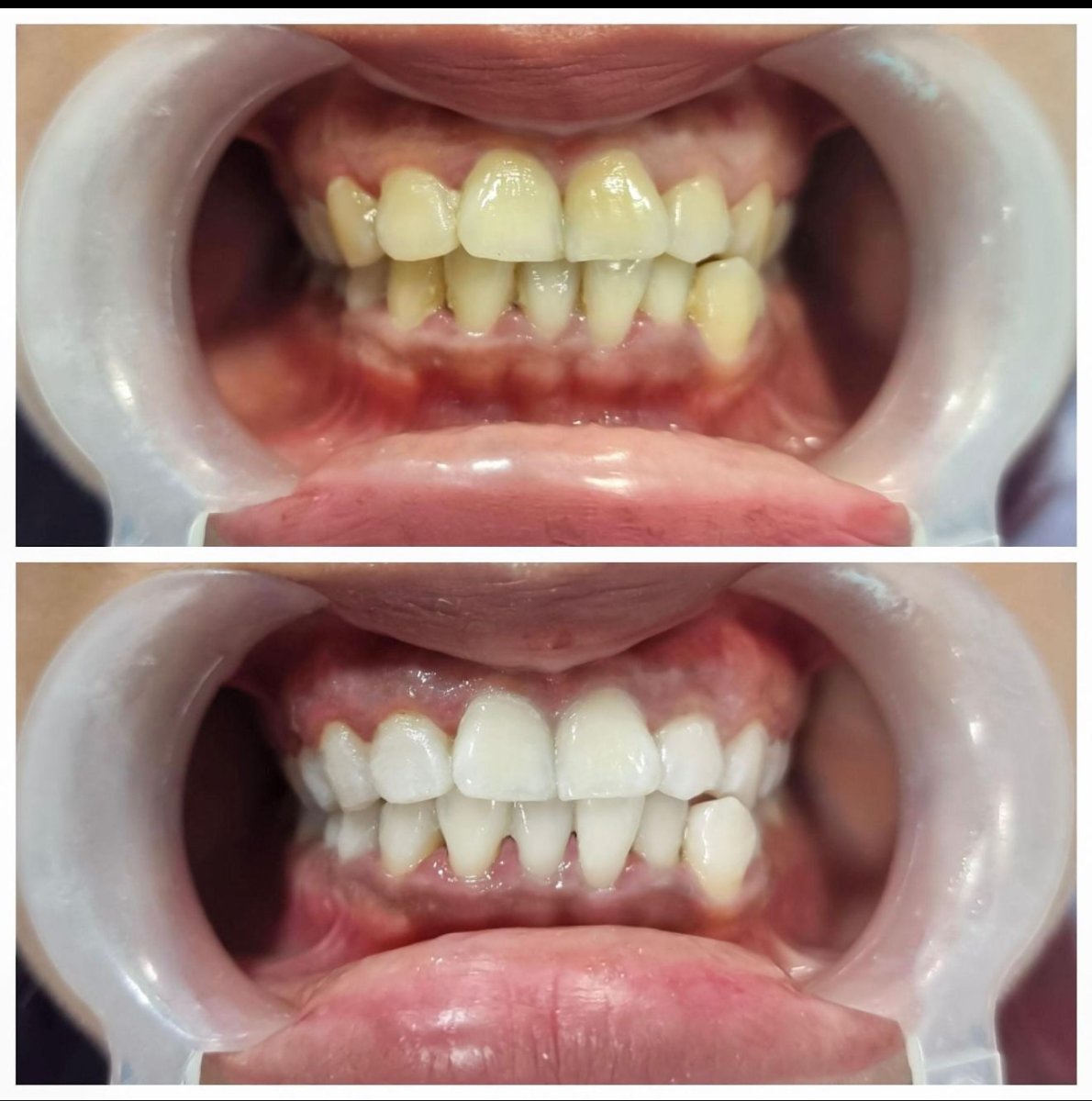 Результаты лазерного отбеливания зубов до и после в Grand Dental Hospital & Laboratory