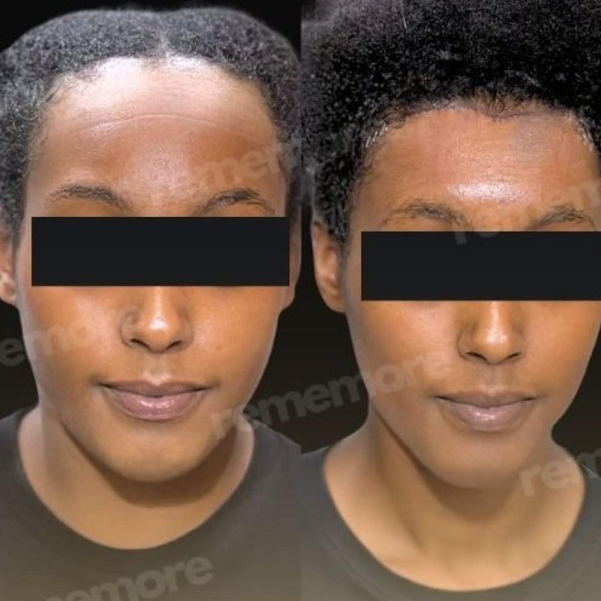 Forehead lift before and after results at Memorial Bahçelievler Hospital, smoother forehead skin