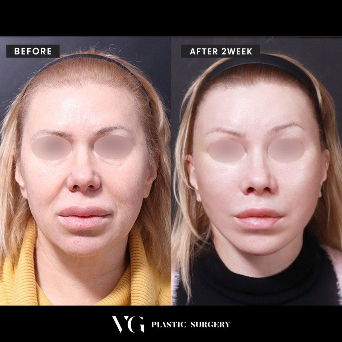 Résultats avant/après du remodelage du front chez VG Plastic Surgery, forme améliorée