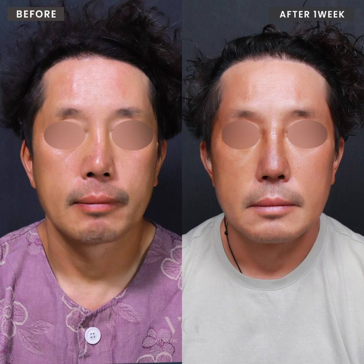 Résultats avant et après rhinoplastie chez VG Plastic Surgery, remodelage du nez après 1 semaine