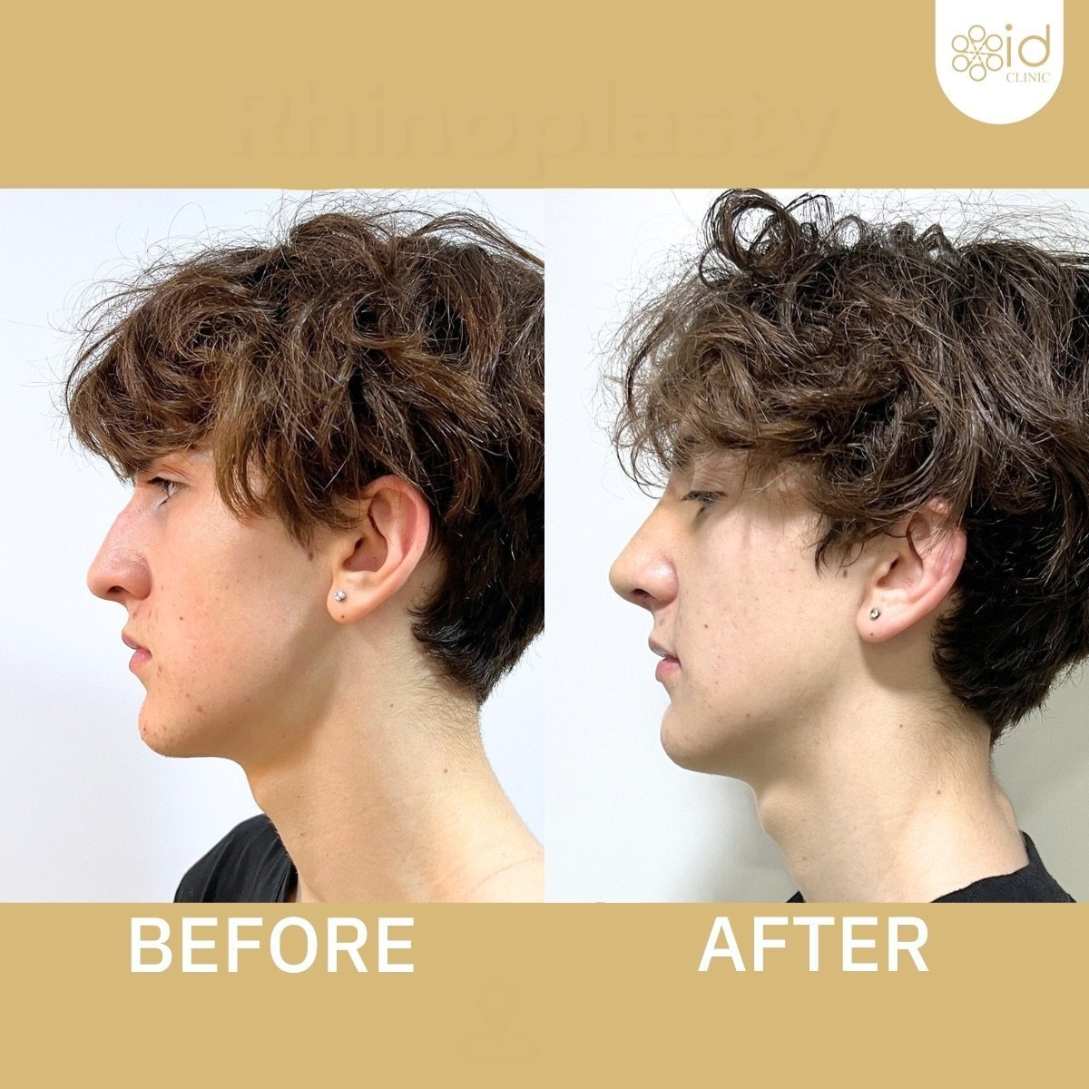 Before and after ultrasonic rhinoplasty results at ID Clinic Bangkok, improved nose profile