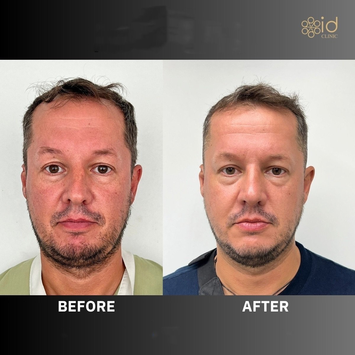 Before and after ultrasonic rhinoplasty result at ID Clinic Bangkok, improved nose contour