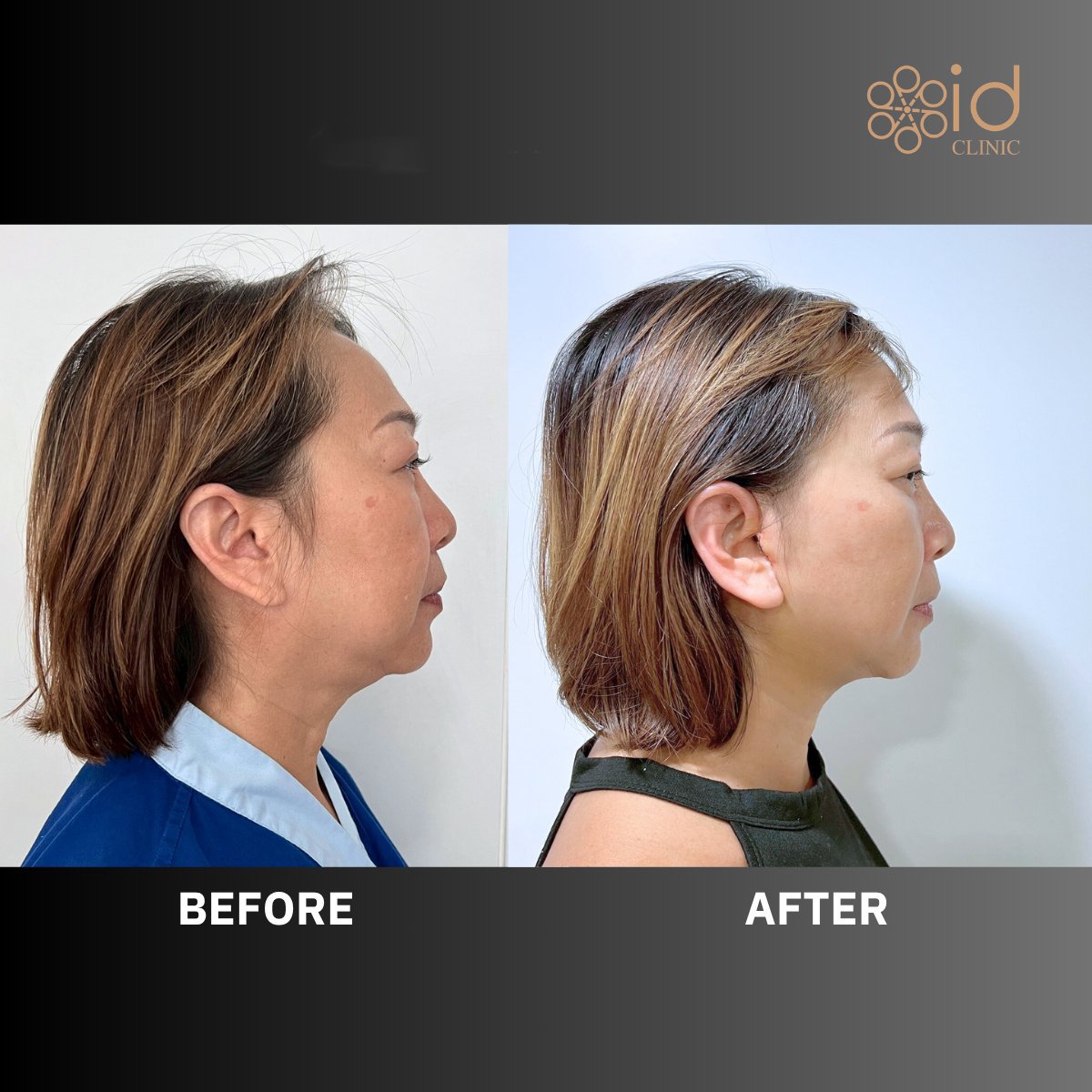 Facelift before and after results at ID Clinic Bangkok, visible facial contour improvement
