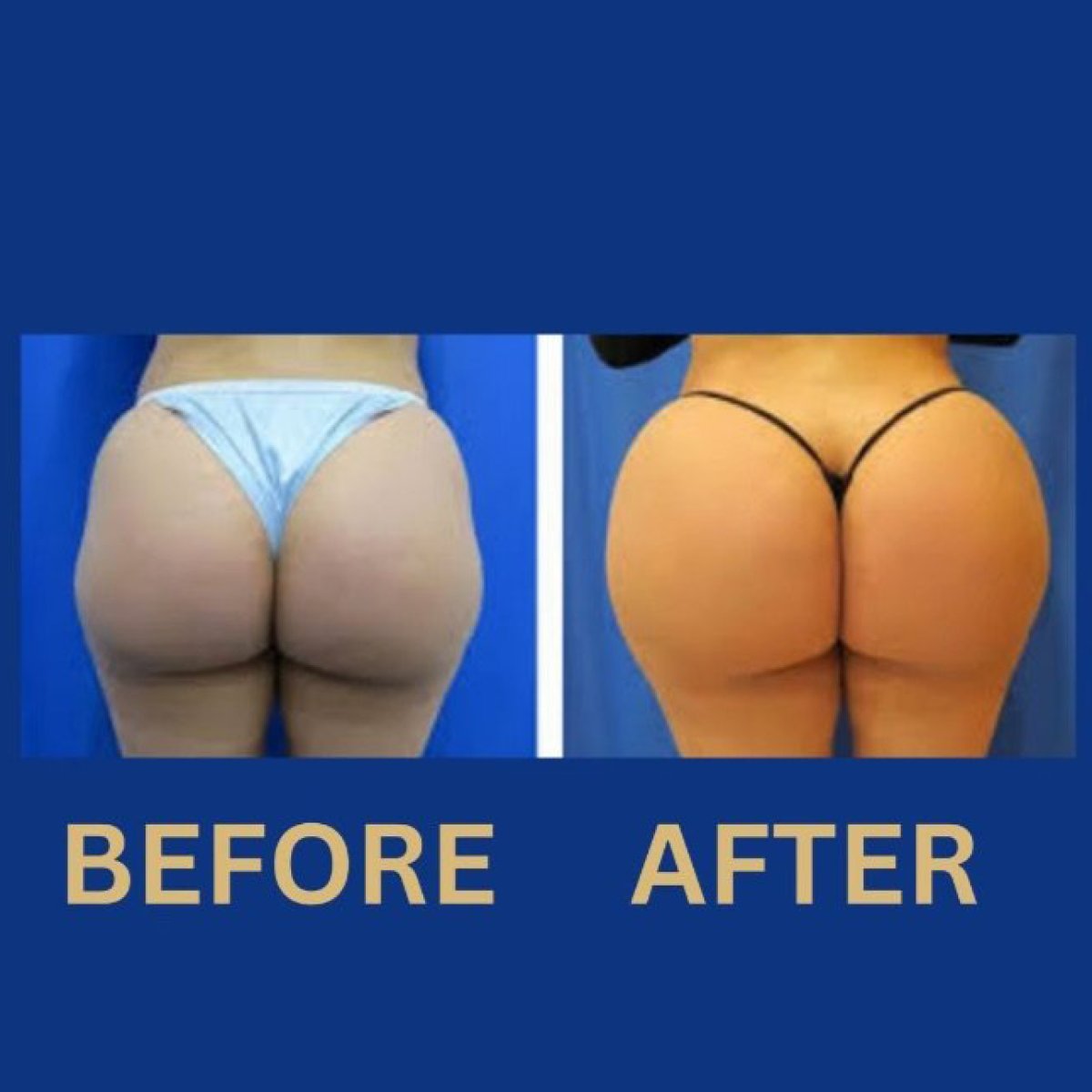 Before and after buttock lift results at ID Clinic Bangkok, enhanced contour and volume