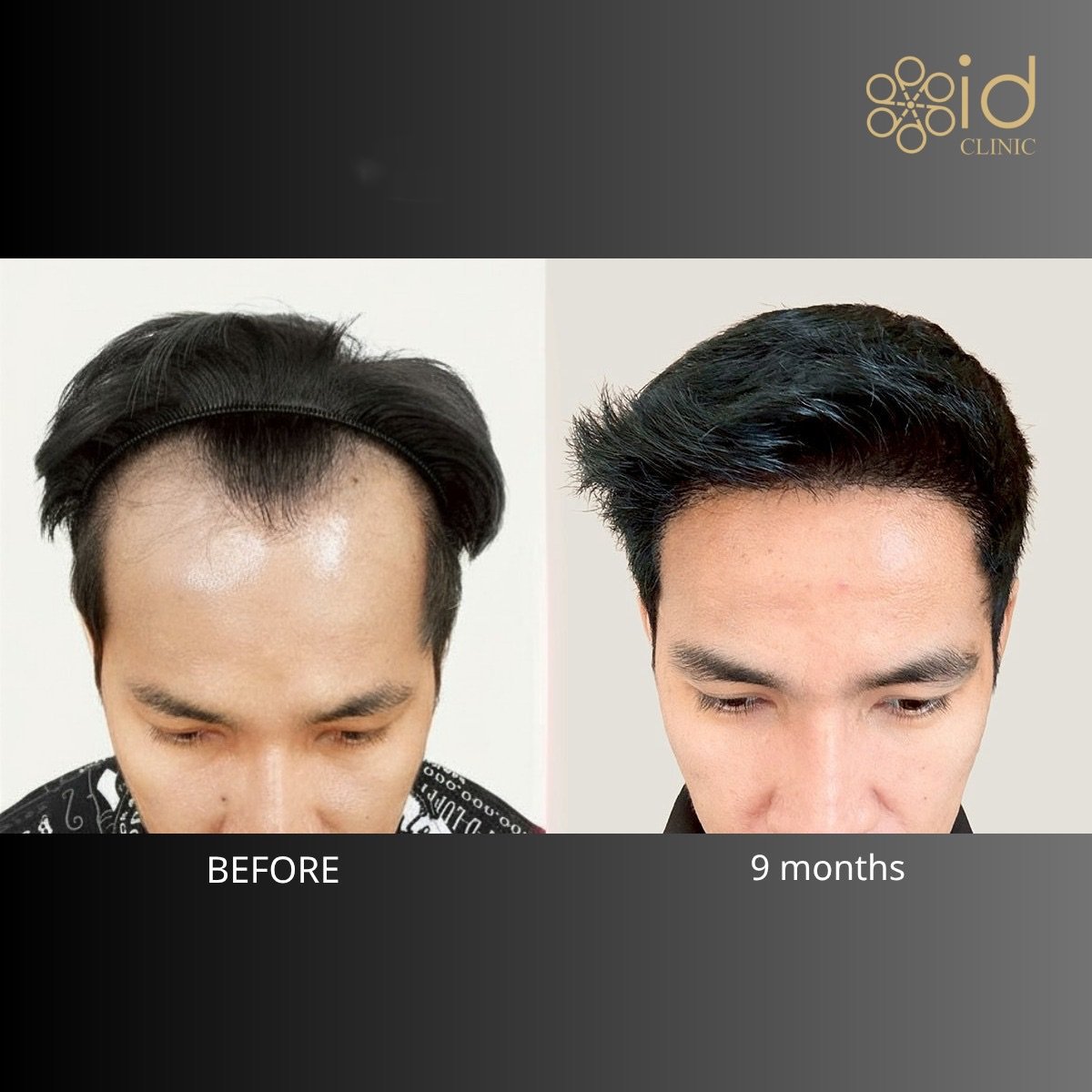 Before and after FUE hair transplant results at ID Clinic Bangkok, fuller hairline in 9 months