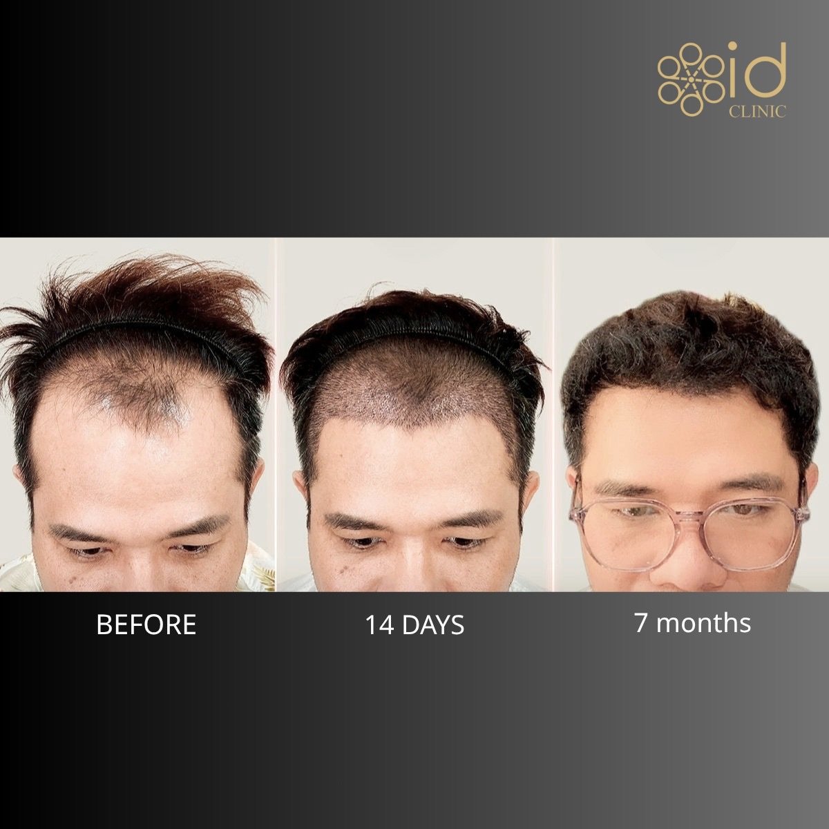 FUE hair transplant before and after results at ID Clinic Bangkok – visible hairline improvement