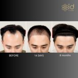 Before and after FUE hair transplant photos by Dr. Dr Phatcharasak Kraisornphongsakul Md