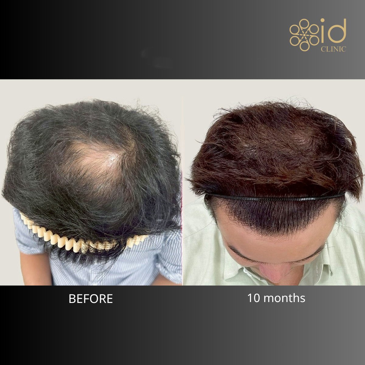 Before and after hair transplant result at ID Clinic Bangkok – fuller hair after 10 months