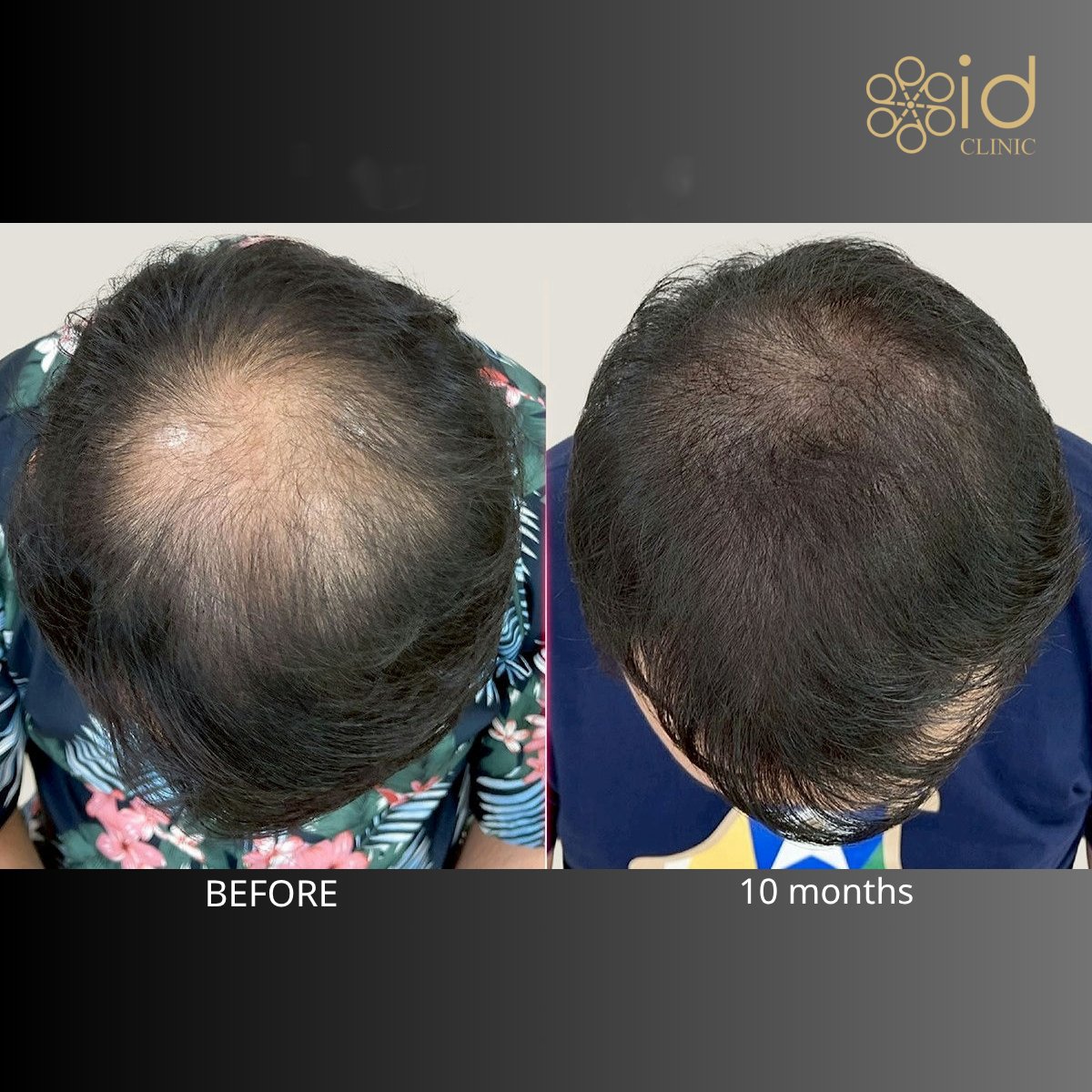 Before and after hair transplant result at ID Clinic Bangkok, visible hair density improvement