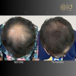 Before and after FUE hair transplant photos by Dr. Dr Phatcharasak Kraisornphongsakul Md