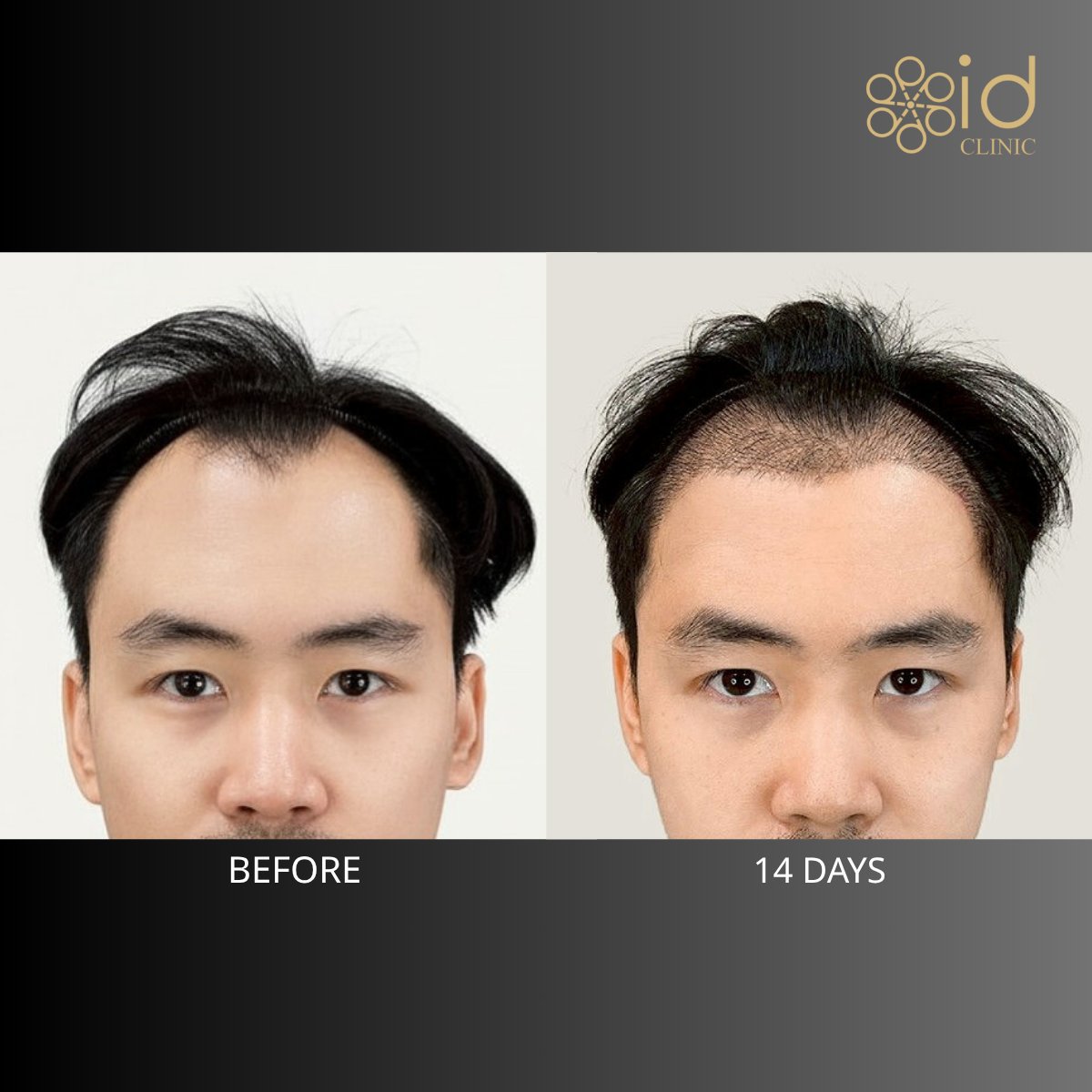 Before and after hair transplant results at ID Clinic Bangkok, improved hairline in 14 days