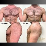 Fotos de antes y después de Cirugía de ginecomastia tomadas por el Dr.(la Dra.) Dr Phatcharasak Kraisornphongsakul Md