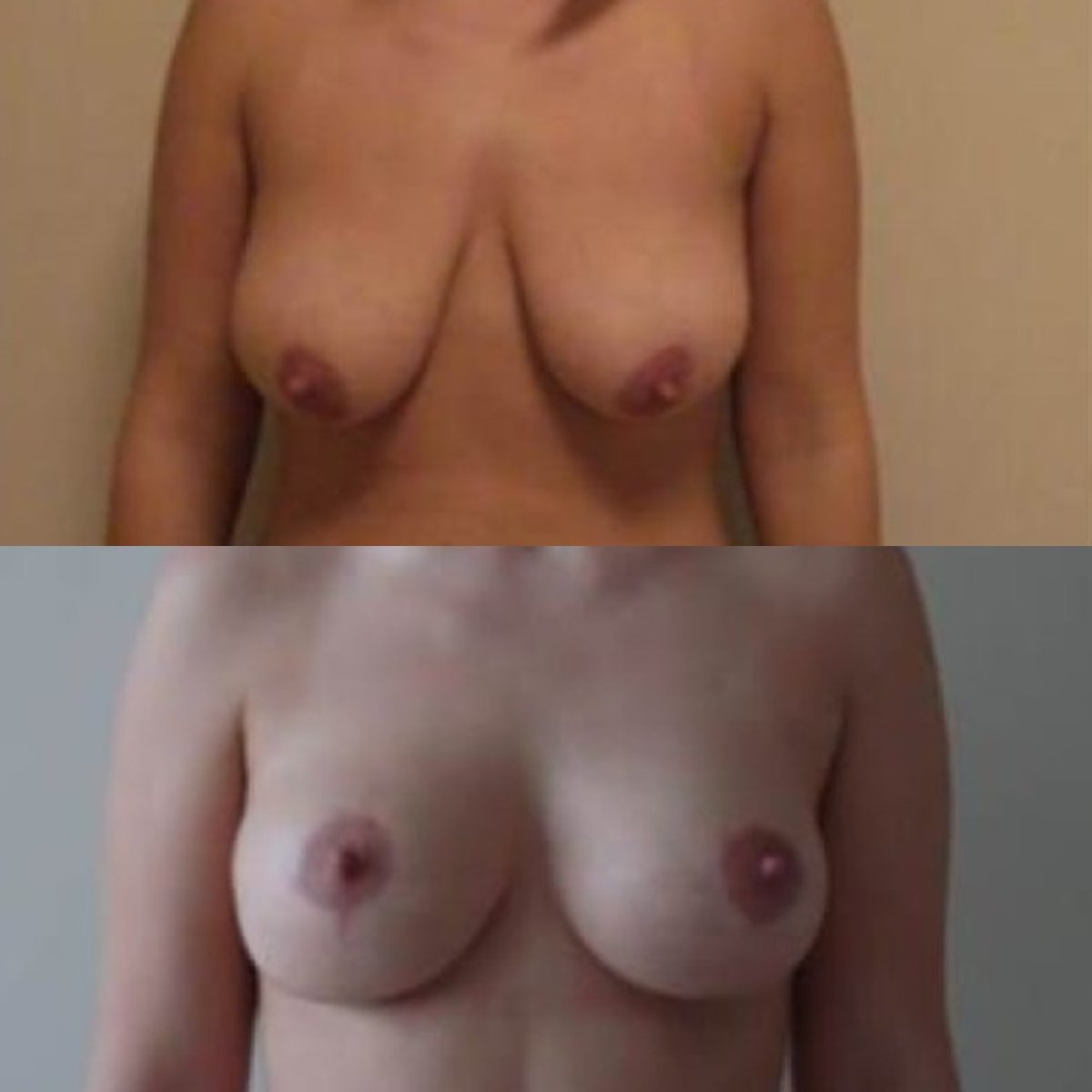 Before and after breast reduction results at Memorial Şişli Hospital, improved breast shape