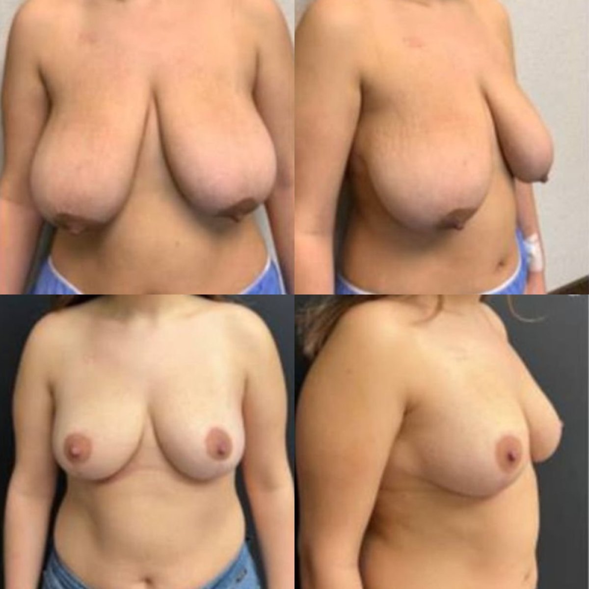 Before and after breast reduction results at Memorial Şişli Hospital, improved breast contour